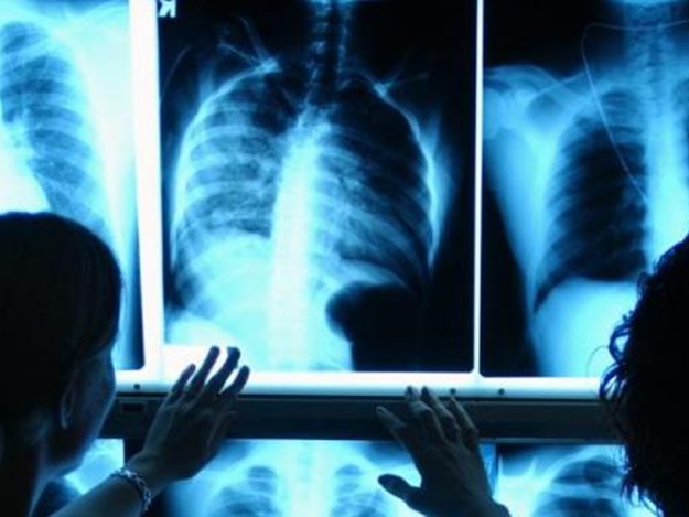 Медиков беспокоит ситуация с туберкулезом в Харькове