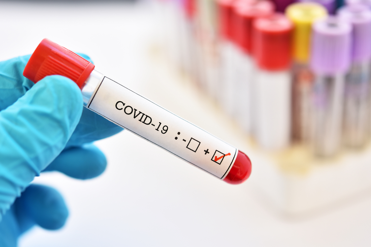 Загруженный лабцентр: тесты харьковчан на коронавирус отправляют в другие области